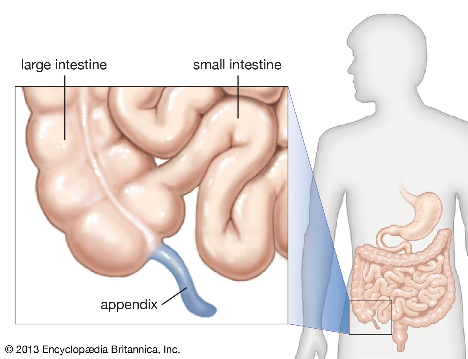 Appendix Cancer